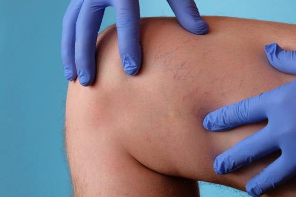 varices varices